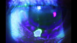 A positive Seidels Test or the corneal waterfall sign [upl. by Ettennyl]