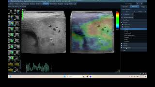 IQ 310 LIVER HEPATOMA ULTRASOUND ECHOPAC ANALYSIS ELASTOGRAPHY [upl. by Ariada]