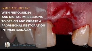 Immediate implant using Fibroguide® and Digital Impressions [upl. by Burton]