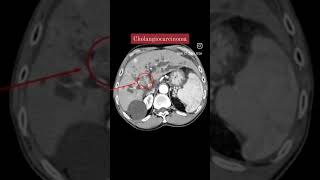 Cholangiocarcinoma CT Abdomen shorts shortsvideo viral [upl. by Seaver]