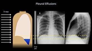 How to Interpret a Chest XRay Lesson 6  Diaphragm and Pleura [upl. by Atteuqal574]