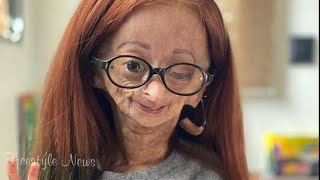 YouTube star Adalia Rose from Texas dies at 15 [upl. by Enalda]