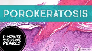 Porokeratosis 5Minute Pathology Pearls [upl. by Donall537]