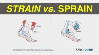 Strain vs Sprain Treatment [upl. by Ylicic]