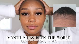 HAIR TRANSPLANT 2 MONTH UPDATE  LONGEVITA [upl. by Aihseym]