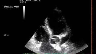 Sub valvular Aortic stenosis  sub Aortic membrane [upl. by Hendricks337]