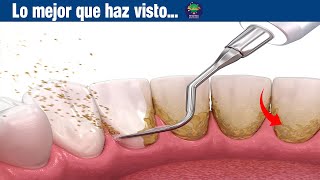 REMEDIO para ELIMINAR PLACAS SARRO y PREVINIR CARIES [upl. by Enahs544]