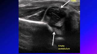 DDH developmental dysplasia of hip congenital hip dislocation CHD [upl. by Stanfill]