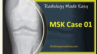 FRCR Radiology MSK Case 01  A 13 yrs old boy presented with pain in the left lower limb [upl. by Diaz]