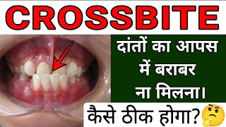 Crossbite Dental Condition 🦷  Cause Problem and Treatment [upl. by Mariele]