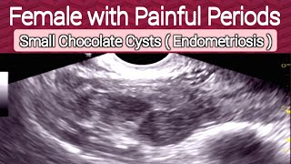 Small Ovarian Chocolate Cysts  Endometriosis  Infertility  Ultrasound [upl. by Sternberg]