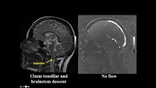 Cine MRI for Chiari I Malformation [upl. by Starla197]