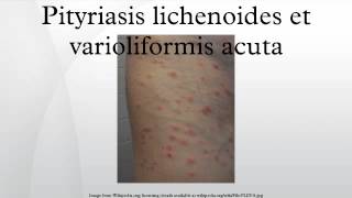 Pityriasis lichenoides et varioliformis acuta [upl. by Ardnu431]