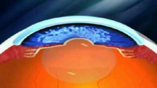 Advance Glaucoma Treatment  Canaloplasty [upl. by Wadleigh256]