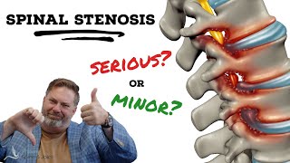 Is Spinal Stenosis serious  The Clinic Episode 1 [upl. by Neirb502]