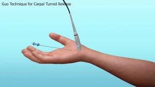 Carpal Tunnel Release [upl. by Atauqal]