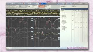 Evoked Potentials  SEP Tibial Nerve [upl. by Garihc]