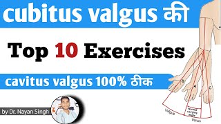 cubitus valgus treatment exercise by doctor  cubitus valgus kya hota hai cubitus valgus vs varus [upl. by Viki]