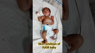 Skin condition of IUGR baby ytshorts shorts trending viralvideo shortsviral new skincare [upl. by Anatol963]