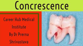 concrescence Developmental tooth anomaly By Dr Prerna Shrivastava career Hub medical institute [upl. by Oluap186]