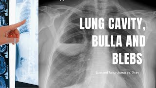 Cavity bulla blebs abscess in a Chest Xray How to differentiate [upl. by Dolph994]