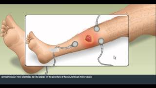 Short Transcutaneous Oxygen Measurement demo [upl. by Ariaz196]