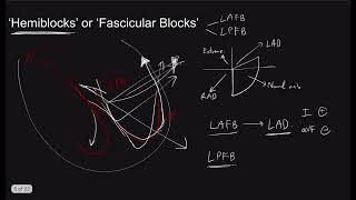 Bundle Branch Block the Series Part 2 AdvancedHemiBifascicular blocks I The Pacemaker [upl. by Nerissa]