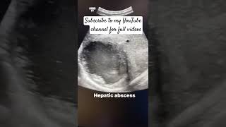 Hepatic abscess on ultrasoundliver AbcessHepatic pathologyultrasound [upl. by Lias]