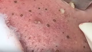 SUPER GIANT BLACKHEAD is here Oddly Video Face Skin with Calm Music [upl. by Hoskinson]