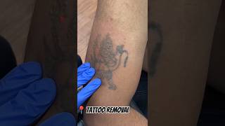 Lazer Tattoo Removal 1st session  SOLID INK TATTOO STUDIO Vijayawada  ☎ 9515174449 [upl. by Akinohs]