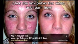 Watch Bio Oil Acne Scars Before amp After Results  Bio Oil Acne Scars Before And After [upl. by Anerehs]