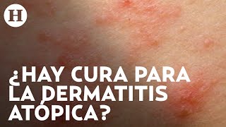 Dermatitis atópica Qué la causa cuáles son los síntomas y qué tratamientos hay  Médico H [upl. by Mani26]