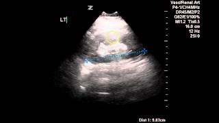 Normal Renal Arterial Doppler  Case Study [upl. by Acinnor654]