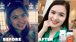 GLUTATHIONE BEFORE AND AFTER How to whiten skin [upl. by Dolhenty]