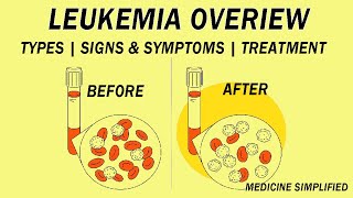 What is Leukemia  Classification Etiology Pathophysiology Clinical Features and Treatment [upl. by Frechette]