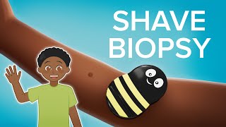 Shave Biopsy  Cincinnati Childrens [upl. by Nim]