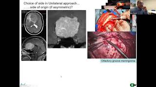 Tuberculum sellae meningiomas [upl. by Eletnahc]