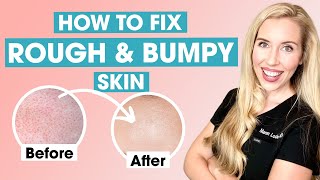 How To Fix Rough and Bumpy Skin  Keratosis Pilaris Affordable Skincare Routine [upl. by Mahgem521]