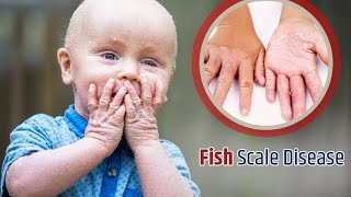 genetic disease ichthyosis vulgaris treatment videos fish scale disease treatment [upl. by Lina898]