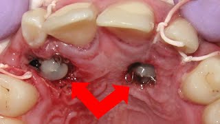 Awful IMPACTED canines  BEFORE and AFTER BRACES time lapse [upl. by Theis598]