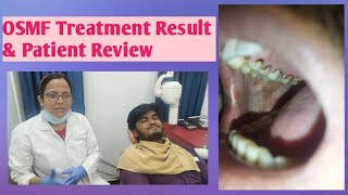 Oral Submucous FibrosisPatient Review and Treatment of OSMFOSMF and its CureOsmf kaise thik kre [upl. by Nosiddam]