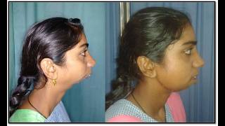 Everything you need to know about facialJawdeformity amp how it is treated by Orthognathic surgery [upl. by Mongeau]