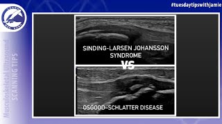 Differentiating SindingLarsen Johansson Syndrome and Osgood Schlatter Disease in the pediatric knee [upl. by Notrab]