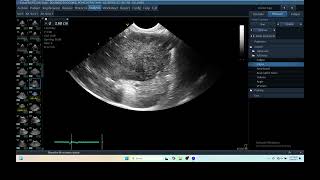 IQ 279 LIVER ULTRASOUND HEPATOMA ECHOPAC ANALYSIS ECHOCARDIOGRAPHY [upl. by Yelram]