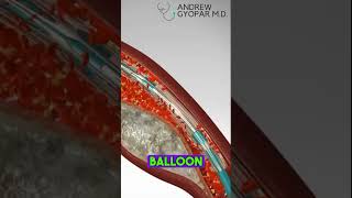 Saving Hearts  Angioplasty Stent Placement HealthAdvice MedicalTips Medicine101 [upl. by Eirelam]