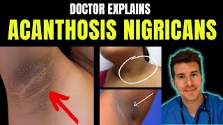 Doctor explains Acanthosis Nigricans  signs symptoms causes treatment and more [upl. by Cagle539]