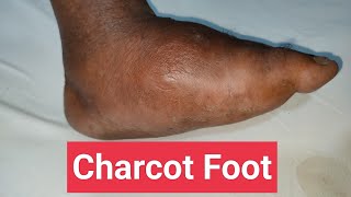 Understanding Charcot Foot in Diabetes Symptoms Treatment and Care [upl. by Gilberto]