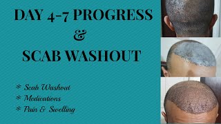 Hair transplant  Progress Day 47 amp Scab Washout [upl. by Seraphim]