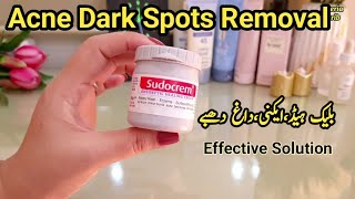 Acne Dark Spots On Face Removal Treatment Plus Blackhead Removal Clear Skin Cream [upl. by Nemajneb281]