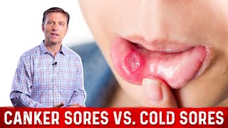 Canker Sores Vs Cold Sores – Dr Berg on Mouth Sores [upl. by Atiuqihc]